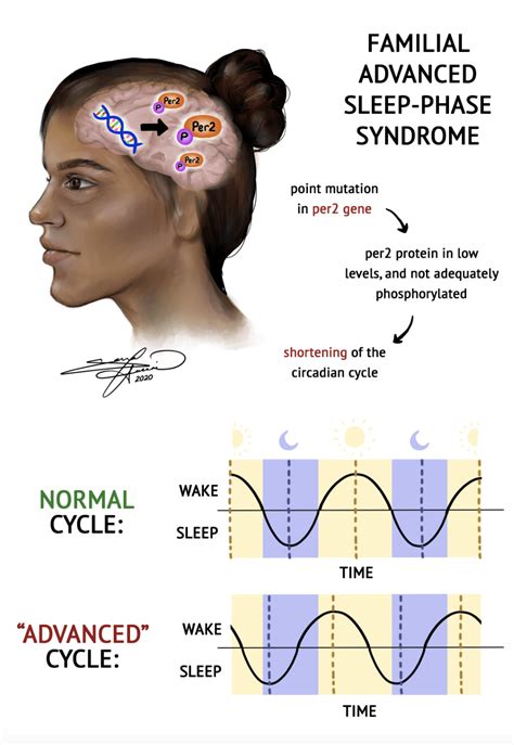 sleep apnea syndrome gene